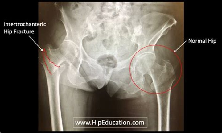 Are comminuted fracture considered displaced?