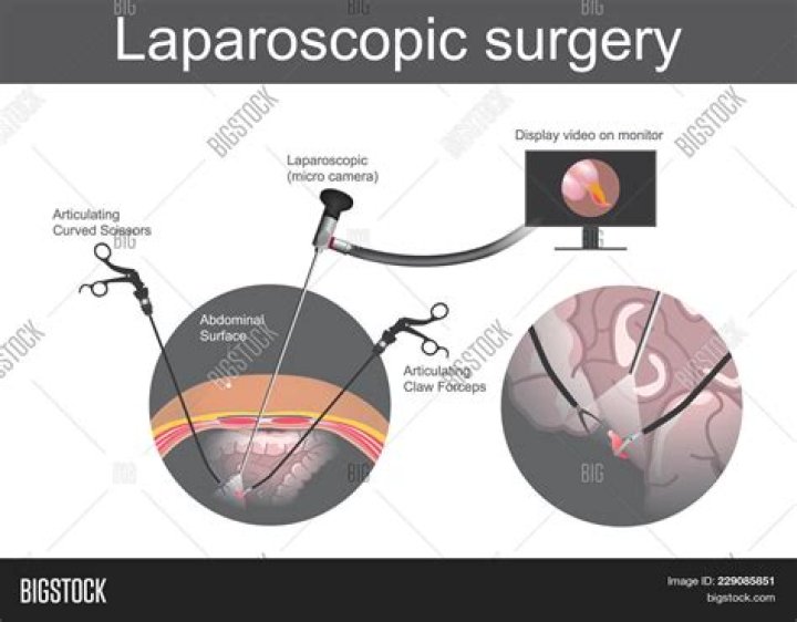 Are laparoscopic surgeries dangerous?