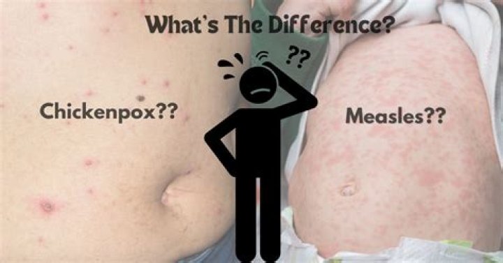 Are measles and chickenpox the same?