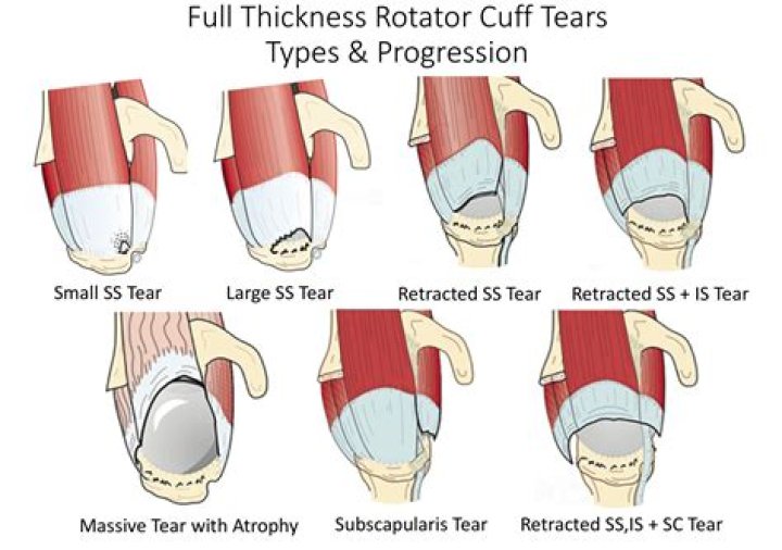 Are rotator cuff problems hereditary?