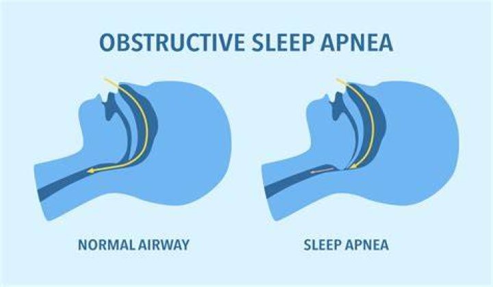 Are you deployable with sleep apnea?