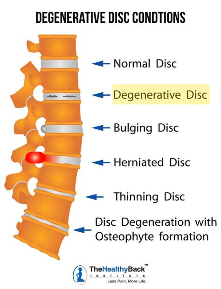 At what age does disc desiccation start?