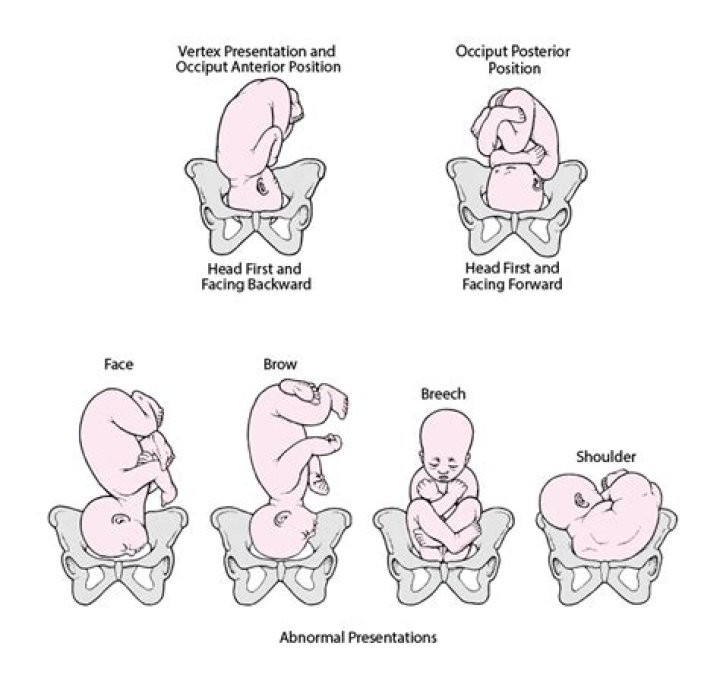 Can cephalic position change?