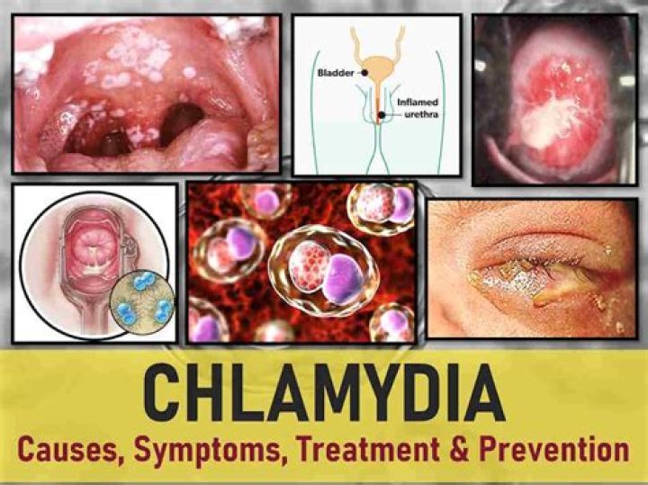 Can chlamydia cause strep throat?