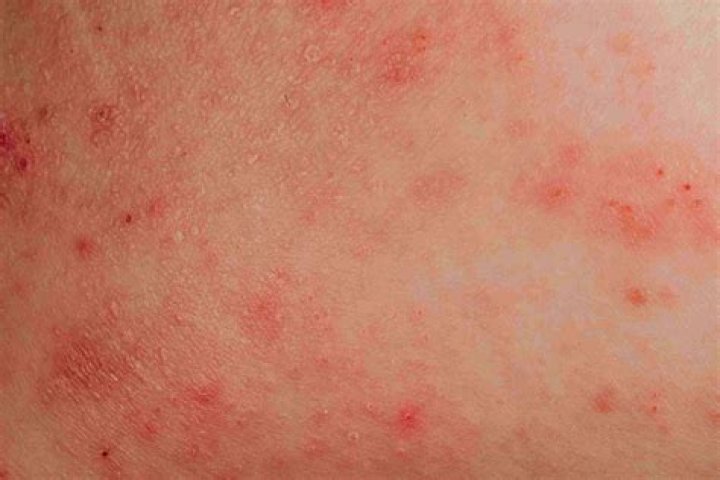 Can eczema be spotty?