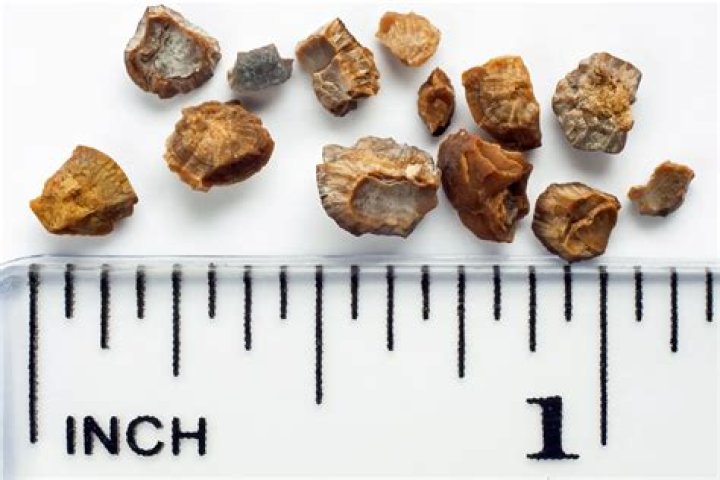 Can kidney stone cause bowel?