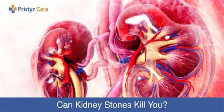 Can kidney stone kill you?