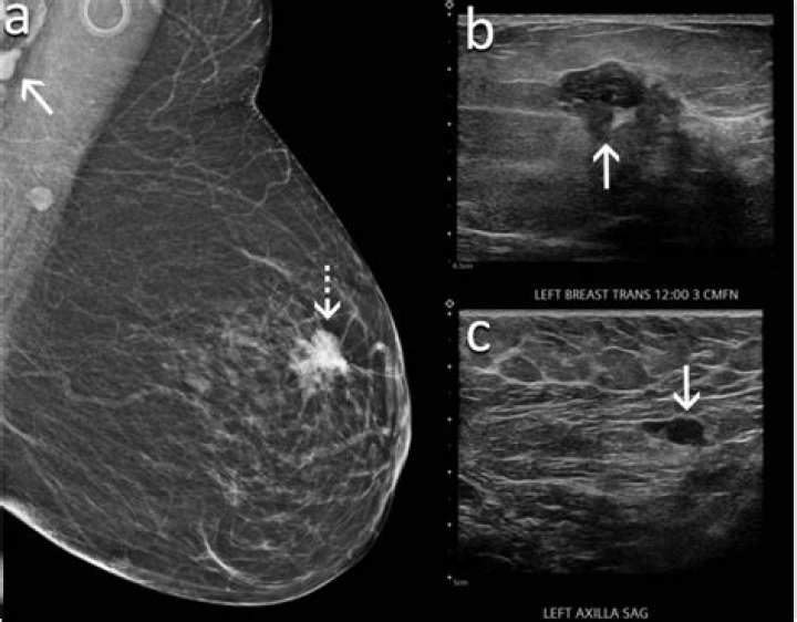 Can malignant breast lump be movable?