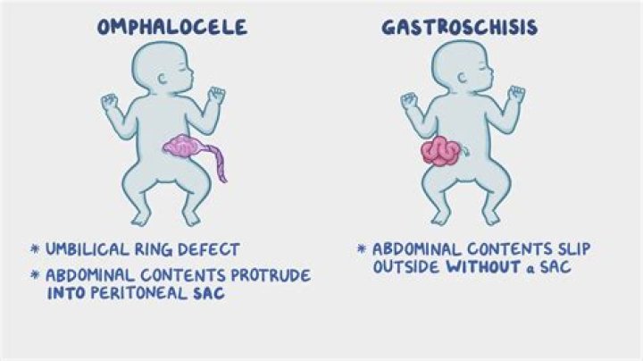 Can omphalocele correct itself?