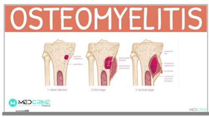 Can osteomyelitis spread to other bones?