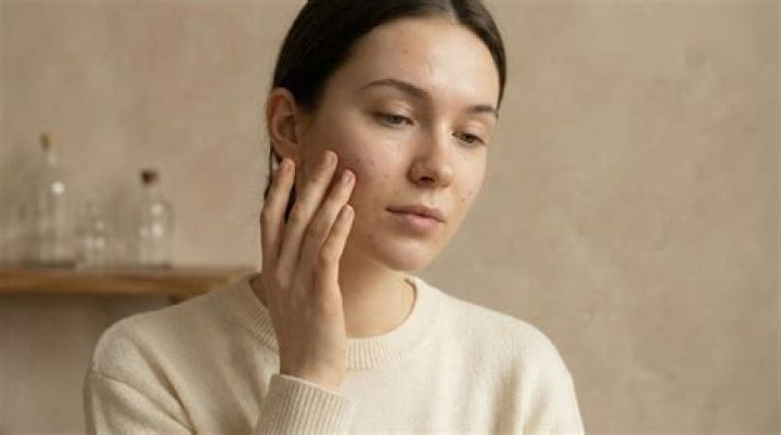 Can progesterone cause acne?