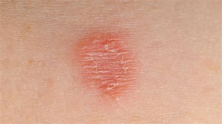 Can ringworm be oval shape?