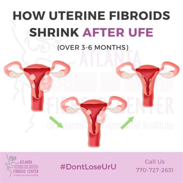 Can shrinking fibroids cause bleeding?