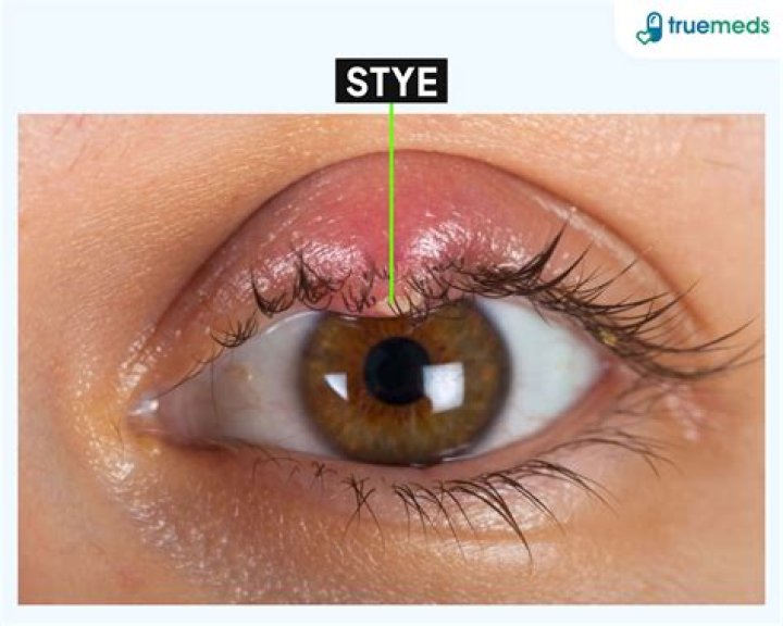 Can styes be itchy?