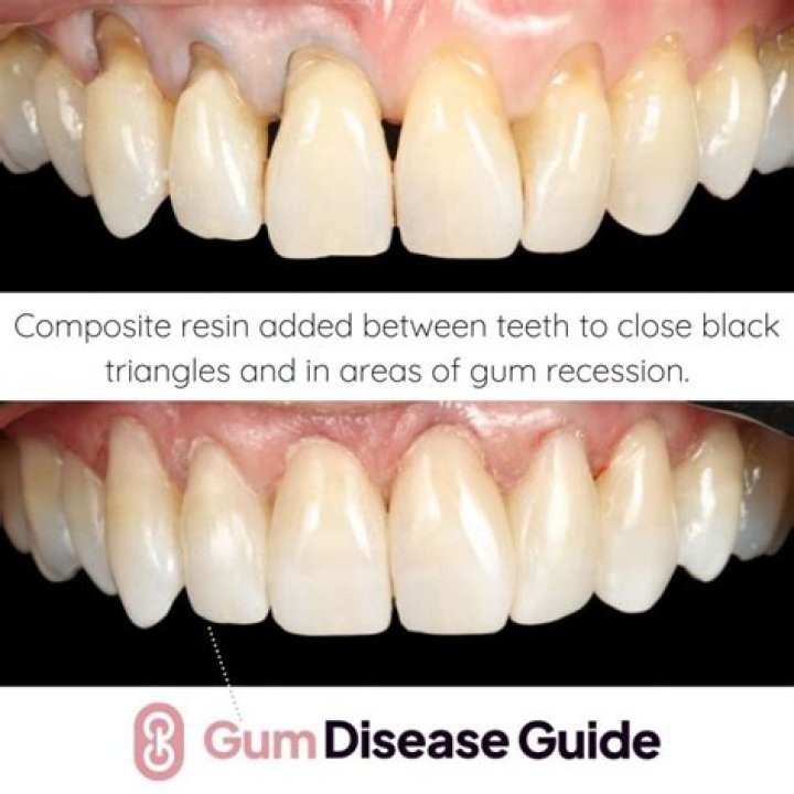 Can teeth be inserted?
