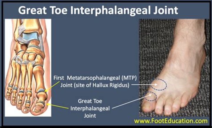 Can toe joints be replaced?
