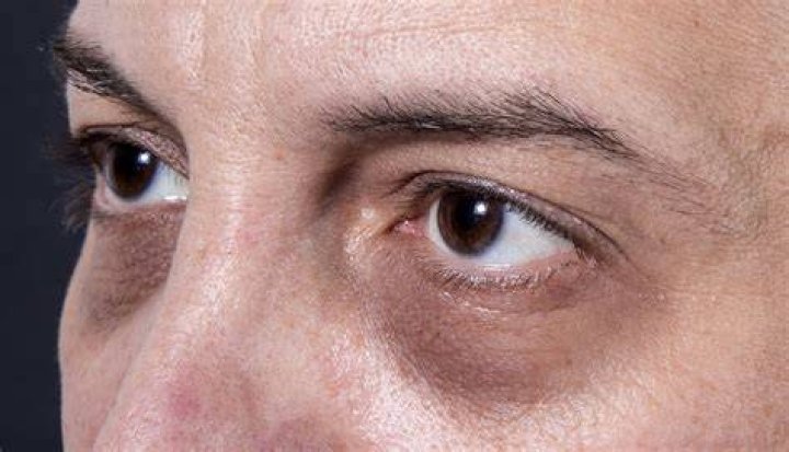 Can you cure hollowing?