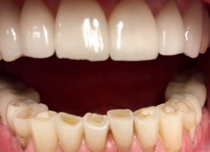 Can you fix a worn down tooth?