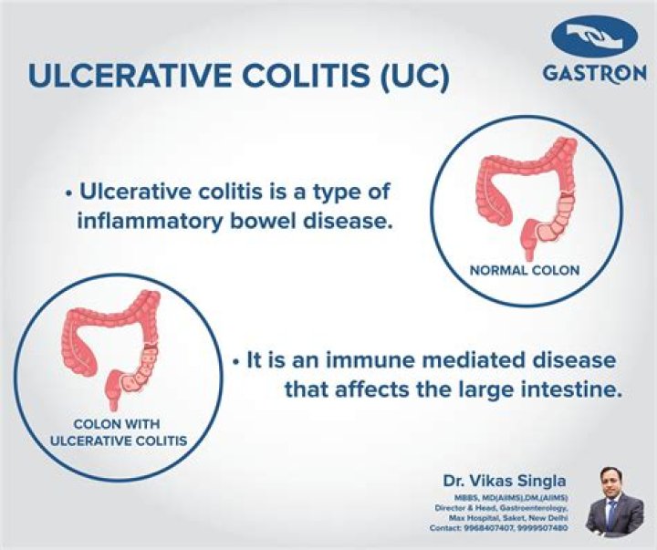 Can you get strictures with ulcerative colitis?