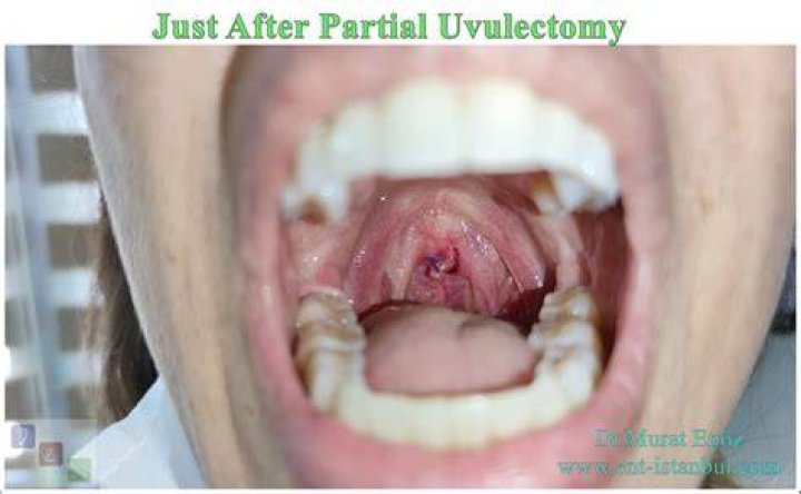 Can you get your uvula removed?