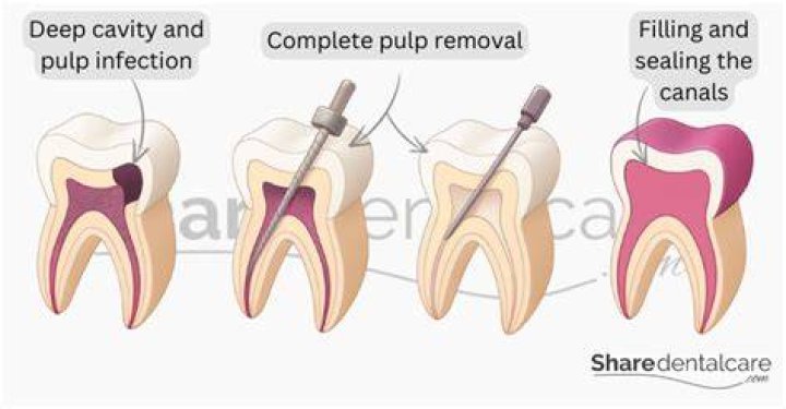 Can you have a pulpectomy?
