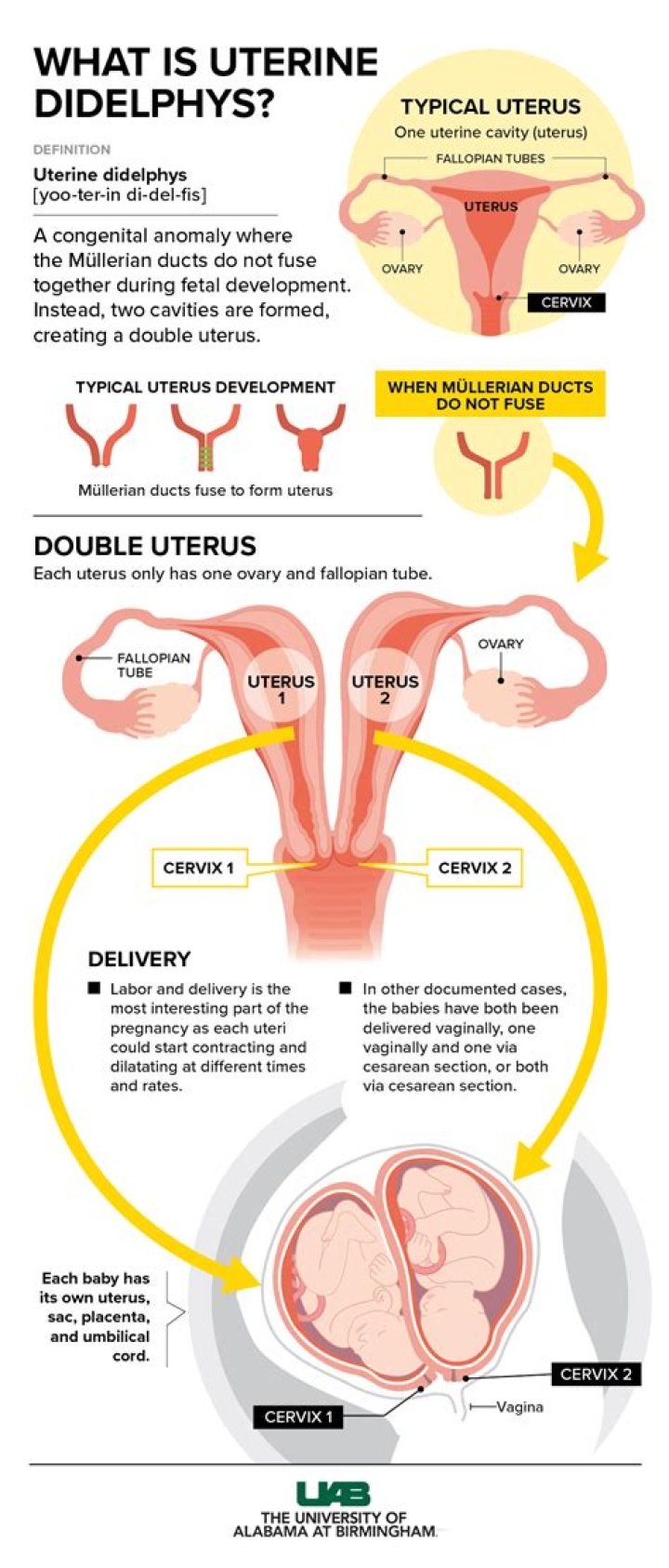 Can you have two wombs?