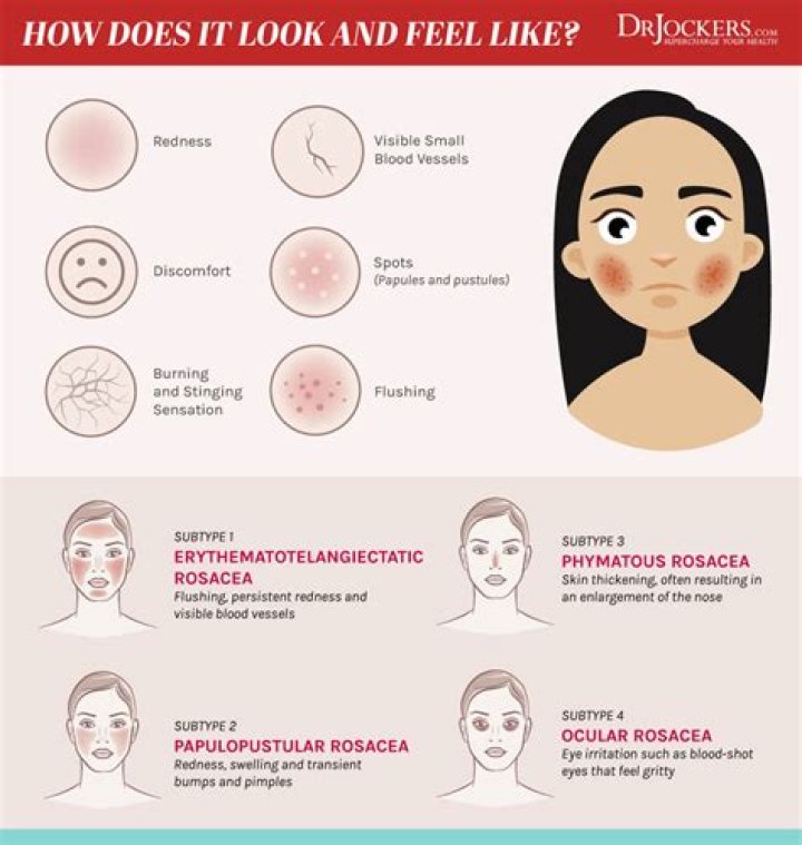 Could digestion cause rosacea?