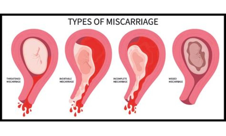 Did pcos cause my miscarriage?