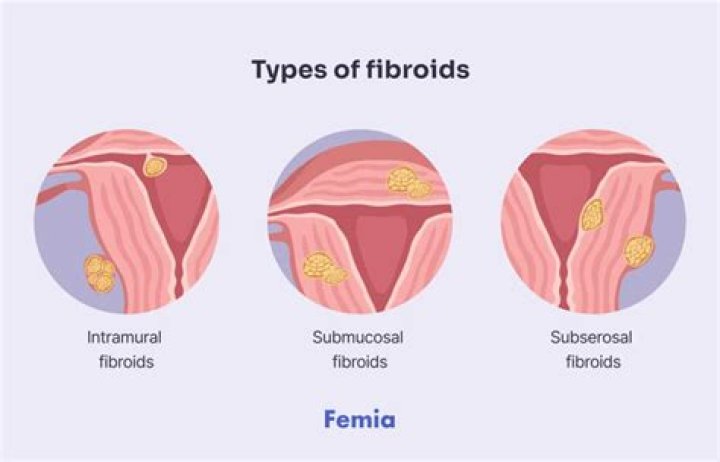 Do fibroids cause necrosis?