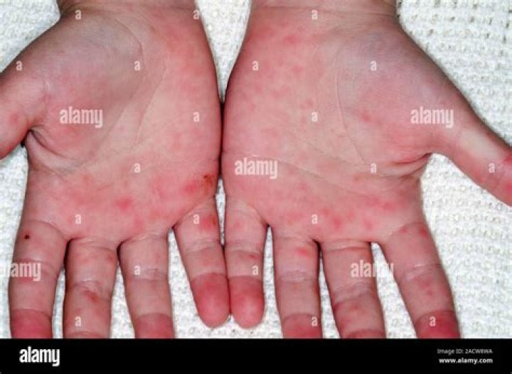 Do hfmd sores itch?