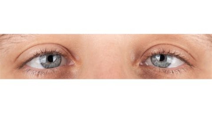Do i have a squint eye?