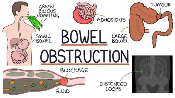 Do intestinal blockages hurt?