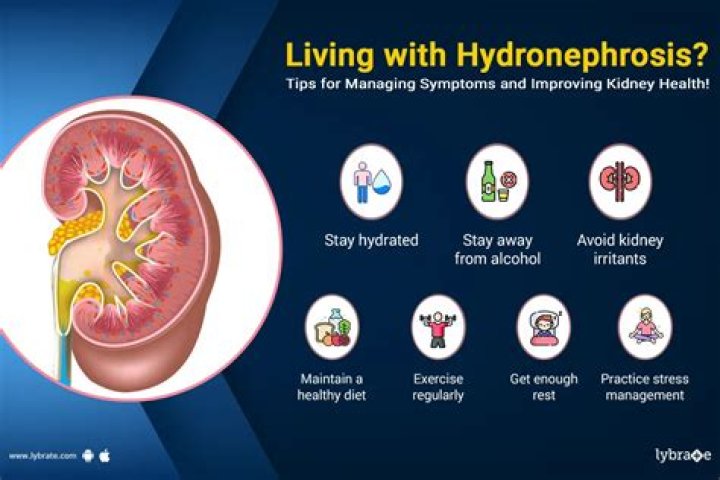 Do kidney stones cause hydronephrosis?