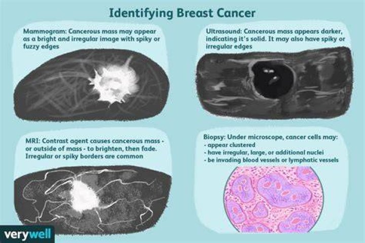Do lumpy breasts mean cancer?