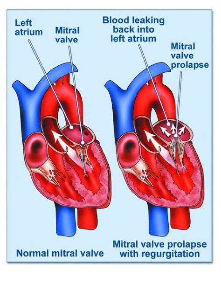 Do mitral valve prolapse go away?