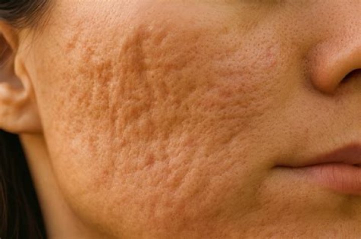 Do pockmarks get worse with age?