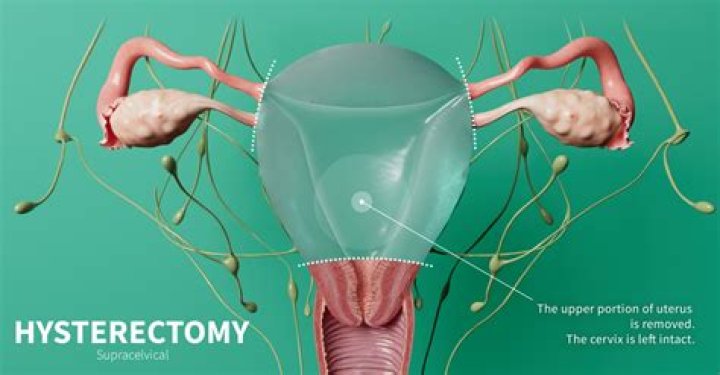 Does a hysterectomy make you postmenopausal?