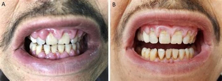 Does amlodipine cause gingival hyperplasia?