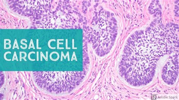 Does basal cell carcinoma metastasize?