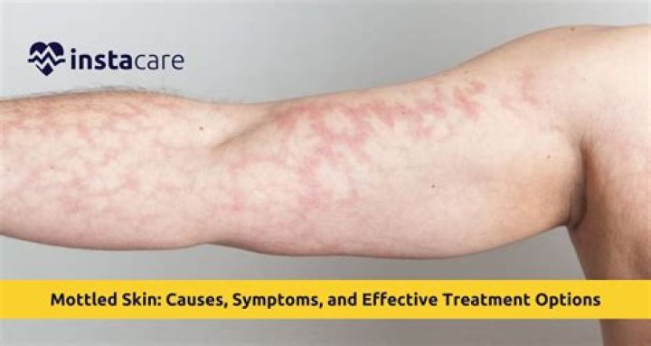 Does being cold cause mottled skin?