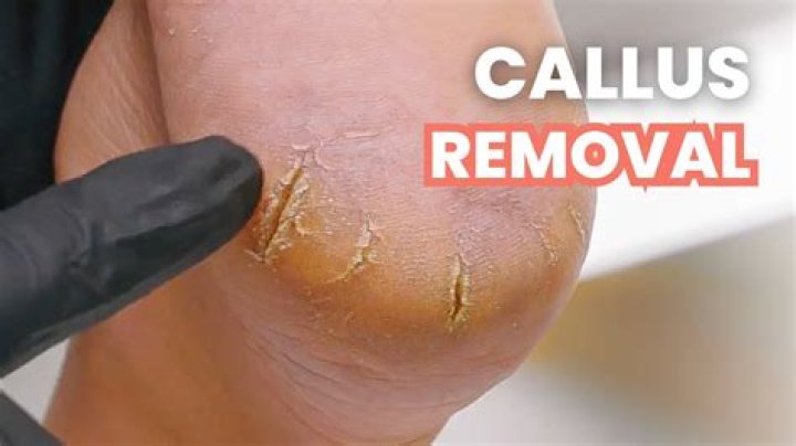 Does callus remover really work?