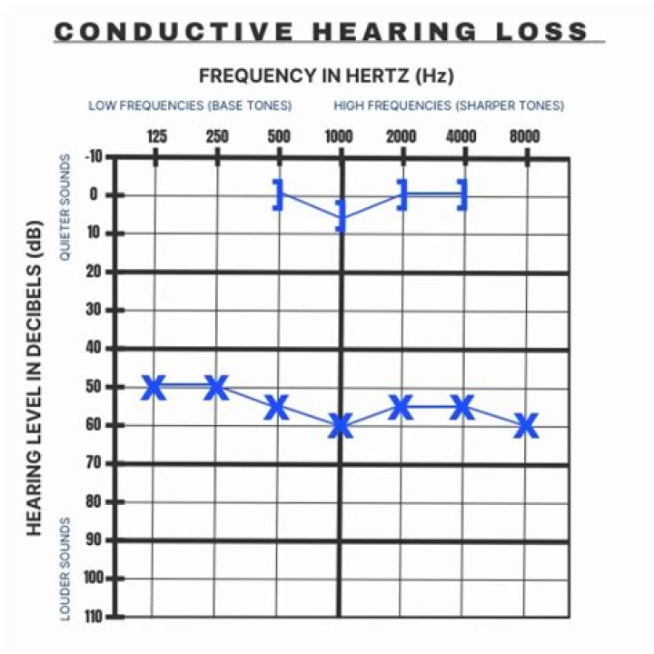 Does conductive hearing loss get better?