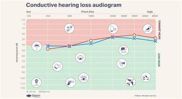 Does conductive hearing loss get worse?