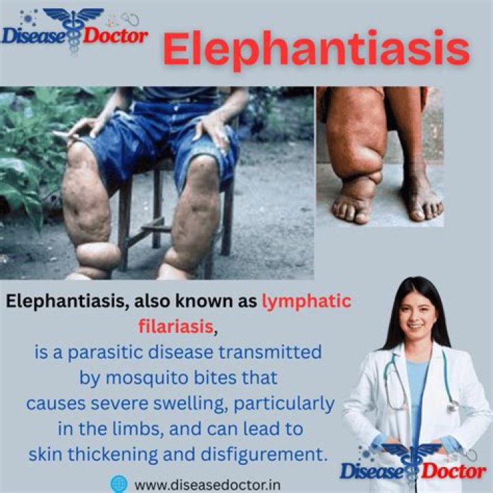 Does elephantiasis affect the legs?