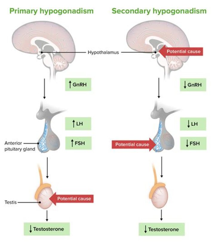 Does epididymitis cause hypogonadism?