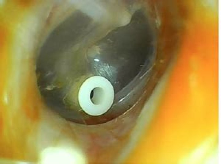 Does grommet affect hearing?