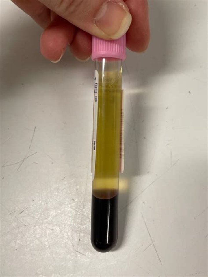 Does hemolyzed mean intact?