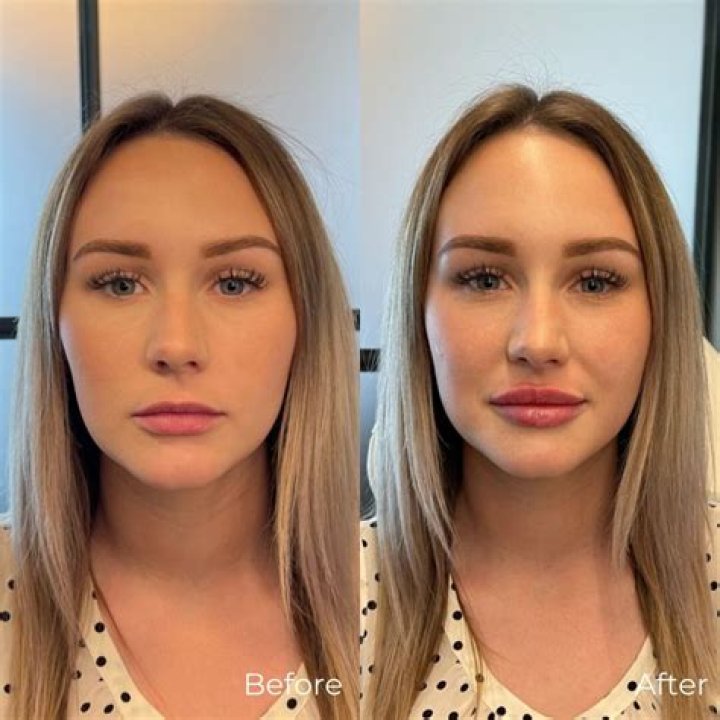 Does insurance cover lip augmentations?