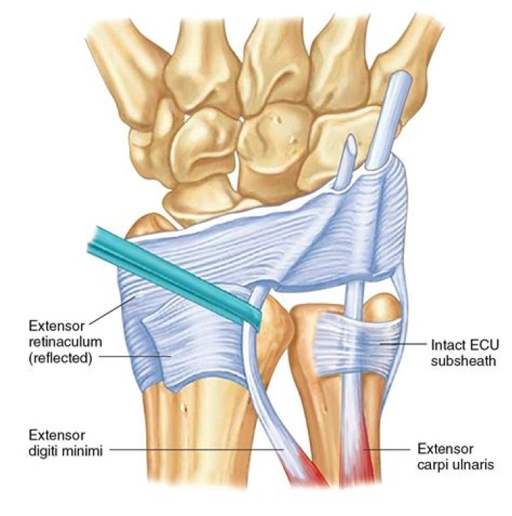 Does medial retinaculum tear require surgery?