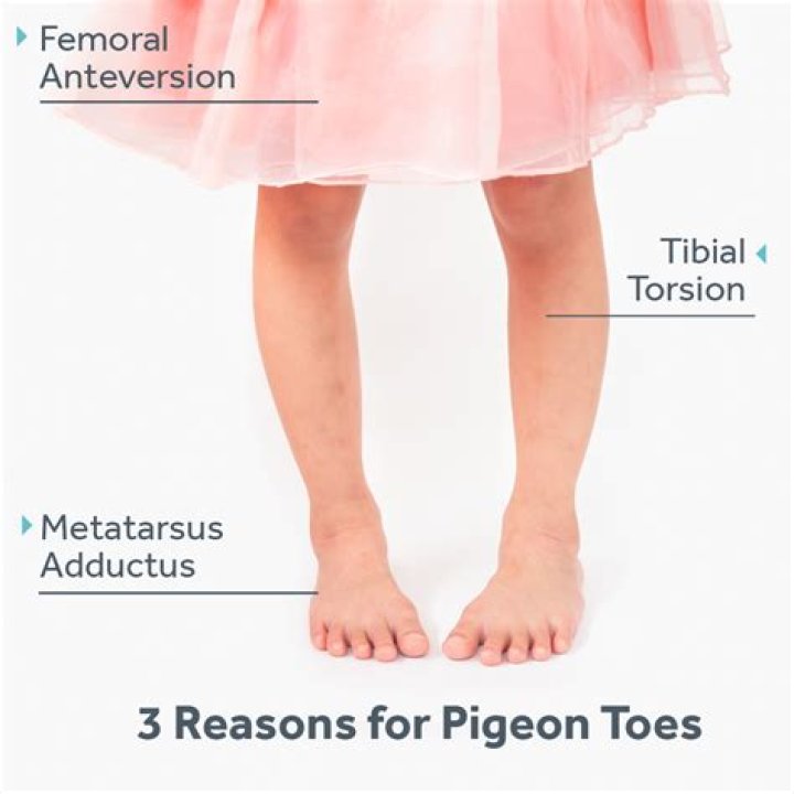 Does pigeon toe go away?